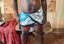 Man and Infant Hospitalized with Severe Burns After Domestic Dispute in Kakamega